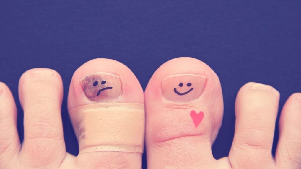 ένα νύχι με μύκητες και ένα υγιές